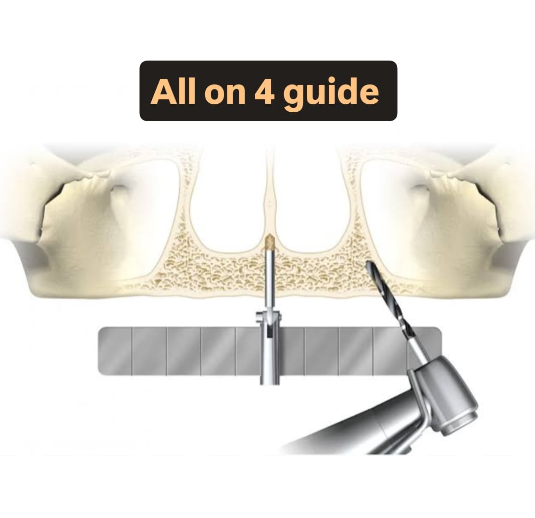 Malo Guide | Surgical Guide for All-on-4 & Full-Arch Implants