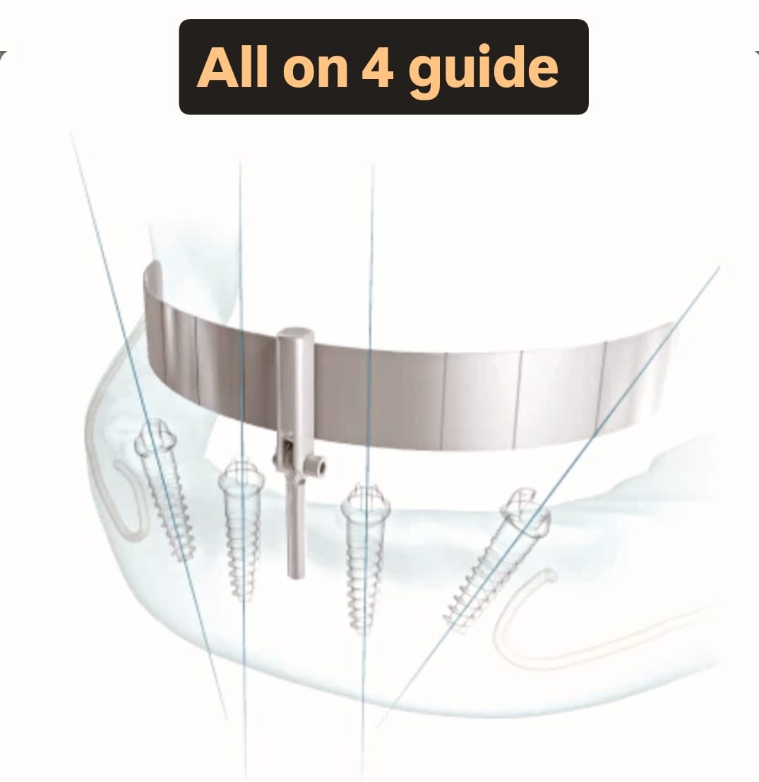 Malo Guide | Surgical Guide for All-on-4 & Full-Arch Implants
